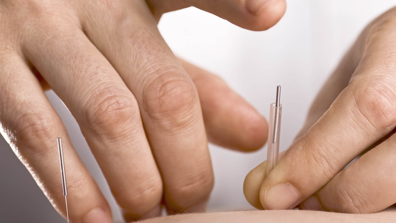 Acupuncturist prepares to tap needle into patients hand