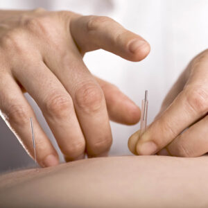 Tapping in acupuncture needle Tapping in acupuncture needle